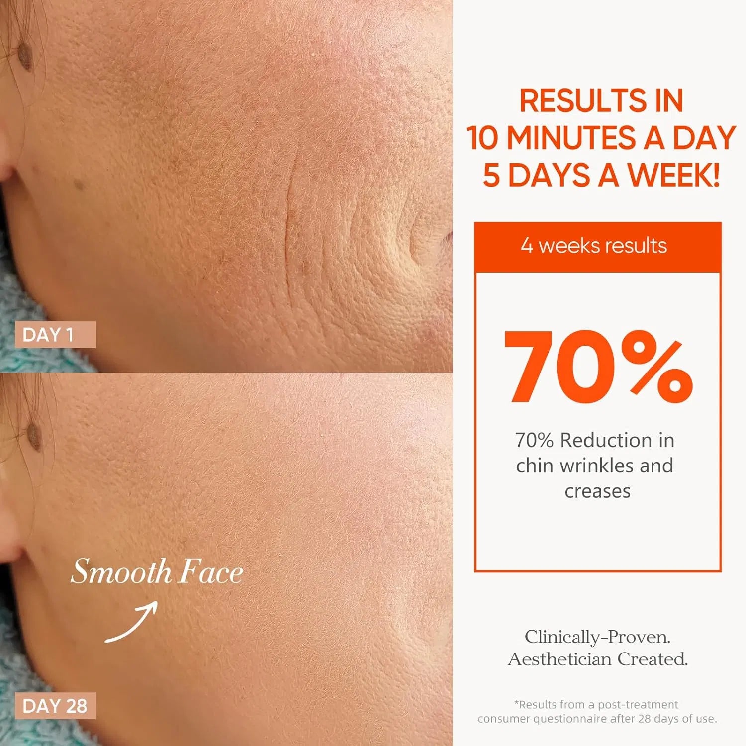 Before-and-after skin comparison showing a 70% reduction in chin wrinkles after 28 days of LED mask treatment.